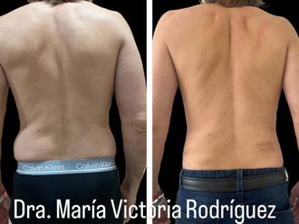 Lipoescultura antes y después - 872799