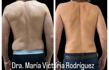 Lipoescultura HD - Dra. Maria Victoria Rodriguez