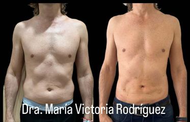 Lipoescultura HD - Dra. Maria Victoria Rodriguez