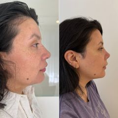 Rinoplastia - Dra. Maria Victoria Rodriguez