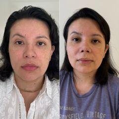 Rinoplastia - Dra. Maria Victoria Rodriguez