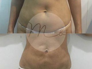 Antes y Despues
