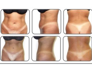 Abdominoplastia