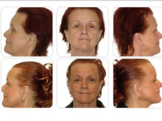 Lifting facial