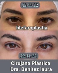 Blefaroplastia - Dra. Maria Laura Benitez