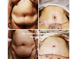 Abdominoplastia