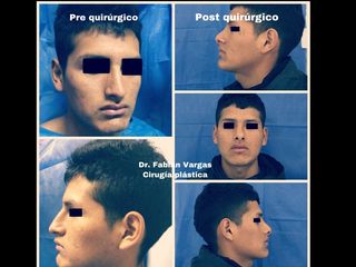 Rinoplastia 