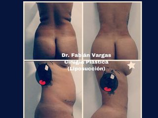 Liposucción