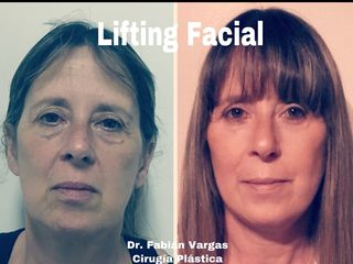 Lifting facial