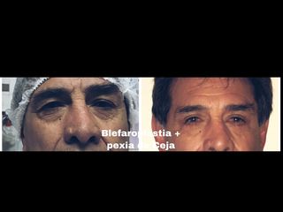 Blefaroplastia