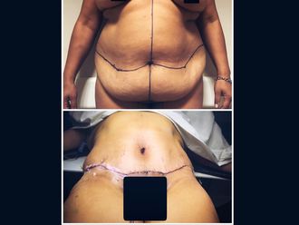 Abdominoplastía - 634049