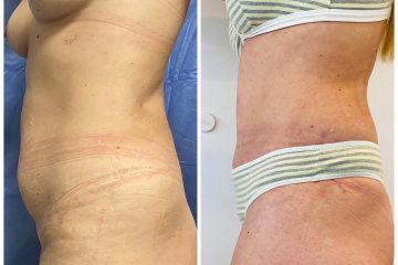 Abdominoplastia - Dr. Fabian Vargas Carrasco