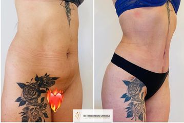 Liposucción - Dr. Fabian Vargas Carrasco