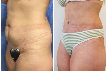 Abdominoplastia - Dr. Fabian Vargas Carrasco