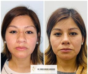 Rinoplastia - Dr. Fabian Vargas Carrasco