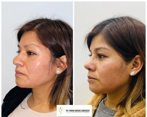 Rinoplastia - Dr. Fabian Vargas Carrasco