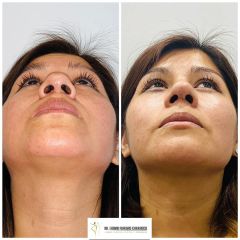 Rinoplastia - Dr. Fabian Vargas Carrasco