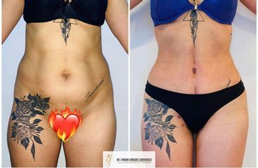 Abdominoplastia - Dr. Fabian Vargas Carrasco