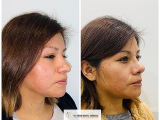 Rinoplastia - 798409