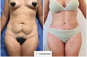 Abdominoplastia - Dr. Fabian Vargas Carrasco