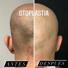 Otoplastia - Clínica Lopez Vargas