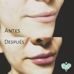 Relleno de labios - Clínica Lopez Vargas