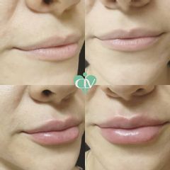 Relleno de labios - Clínica Lopez Vargas