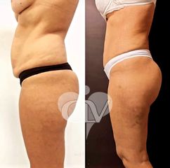 Abdominoplastia - pre y post