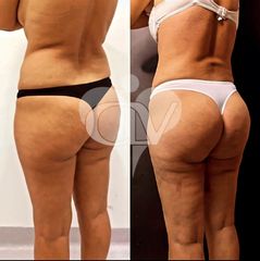 Lipoescultura - Pre y post