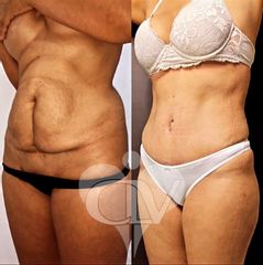 Abdominoplastia - pre y post