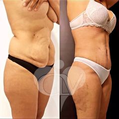 Abdominoplastía. Colgajos que no se van con dieta.