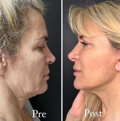 Lifting Facial - Clinica Lopez Vargas