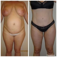 Abdominoplastia + Liposuccion
