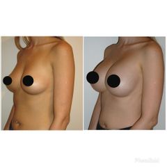 Aumento mamas