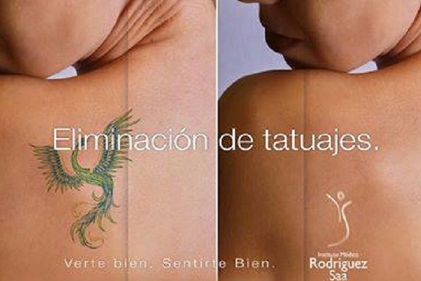 Borrar tatuajes antes y después - 597869
