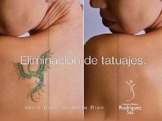 Antes y despues de eliminacion de tatuajes