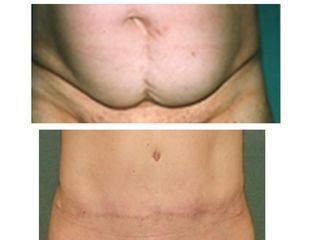 Abdominoplastía