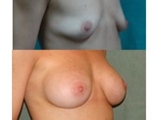 Prótesis mamarias