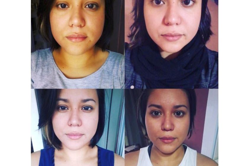 Rejuvenecimiento facial antes y después - 639502