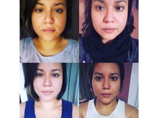 Afinamiento facial