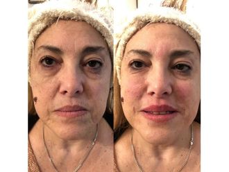 Rellenos faciales - 639504