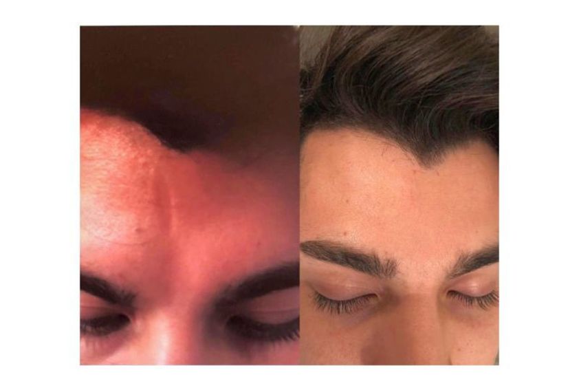 Eliminar cicatrices antes y después - 639505