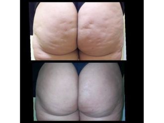 Tratamientos para estrías antes y después - 639512