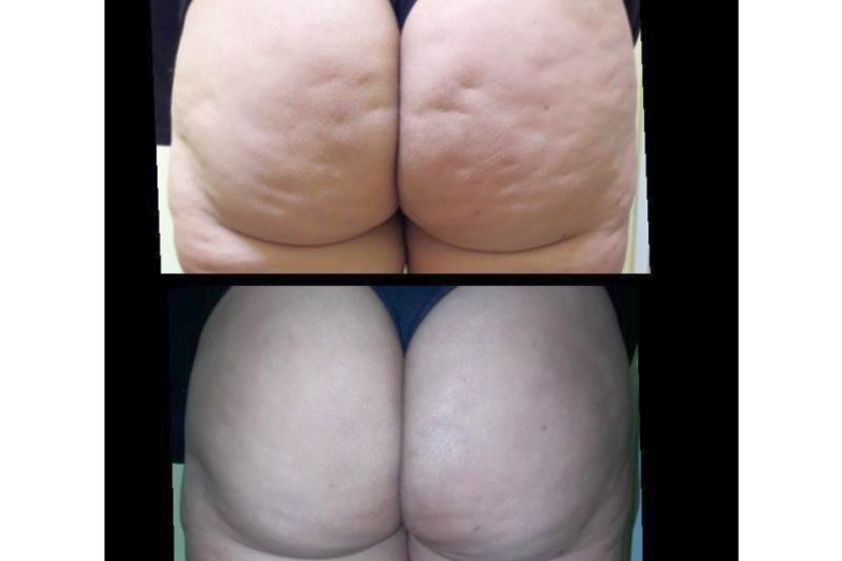 Tratamientos para estrías antes y después - 639512