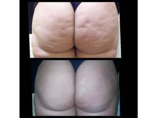 Lipodeep para celulitis