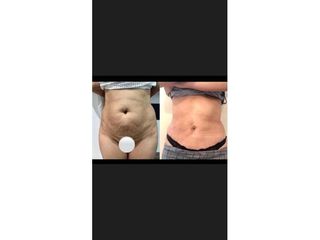 Abdominoplastia