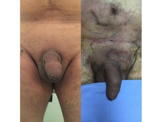 Alargamiento de pene