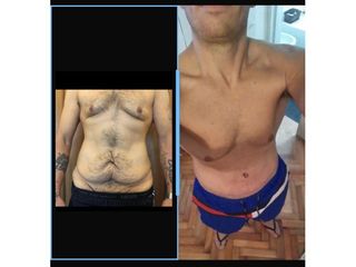 Dermolipectomía