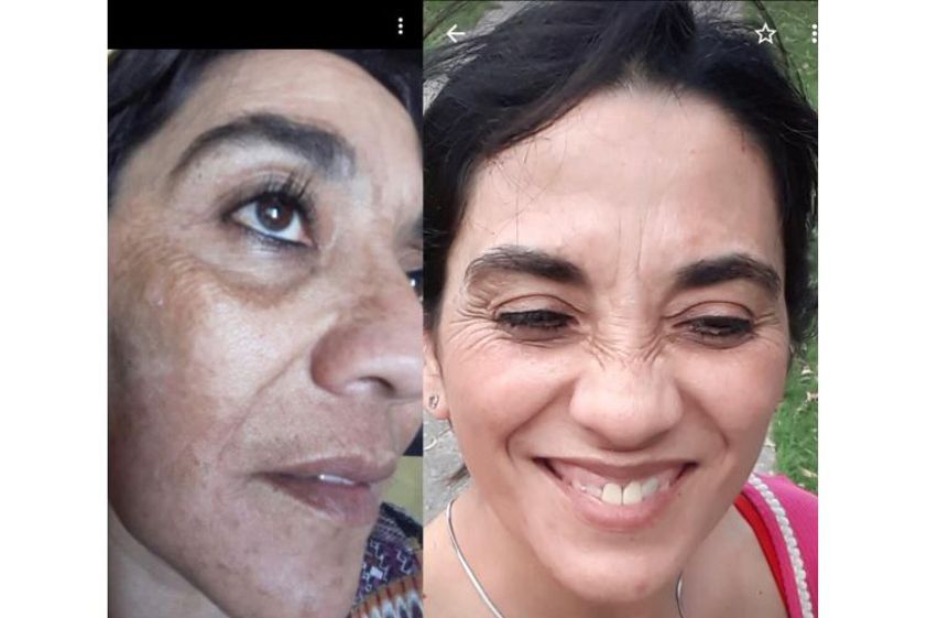 Manchas de la piel antes y después - 647575