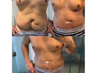 Lipo Láser HD Marcación